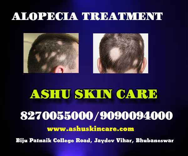 best alopecia treatment clinic in bhubaneswar close to sum hospital